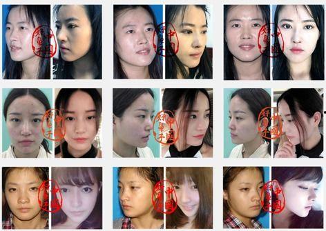 哪些明星隆鼻图片,从这些隆鼻前后对比照看美丽蜕变之路